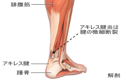 アキレス腱 縮める と 痛い