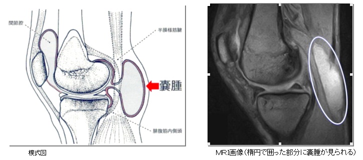 痛み 膝 の 裏側 「スポーツによる膝の慢性障害」｜日本整形外科学会 症状・病気をしらべる