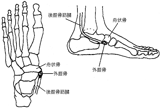 有 痛 性 外 脛骨 障害