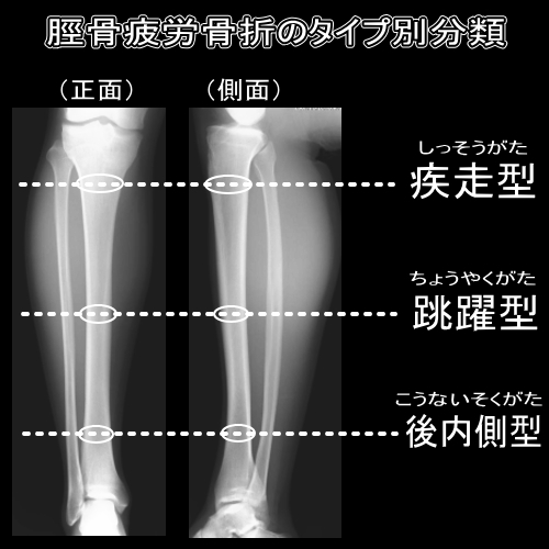 疲労 骨折 湿布