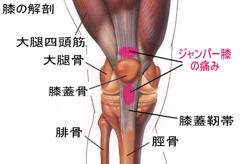 膝の前方の痛み：ジャンパー膝｜よくある症状・疾患｜札幌スポーツクリニック｜札幌市中央区の整形外科・内科・リハビリ科