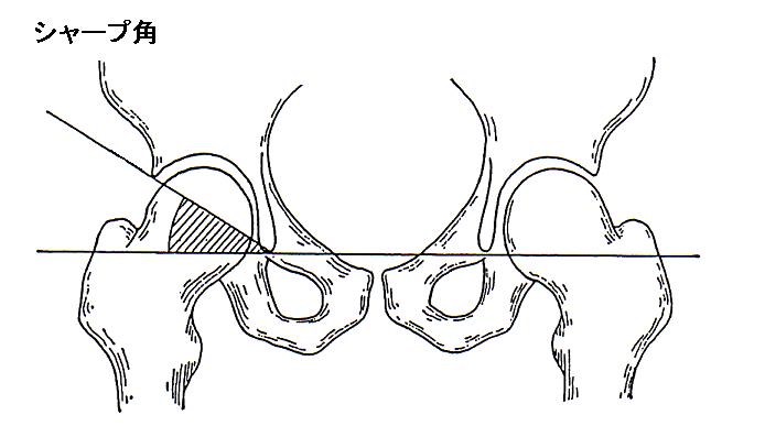 股関節 臼 蓋 形成 不全