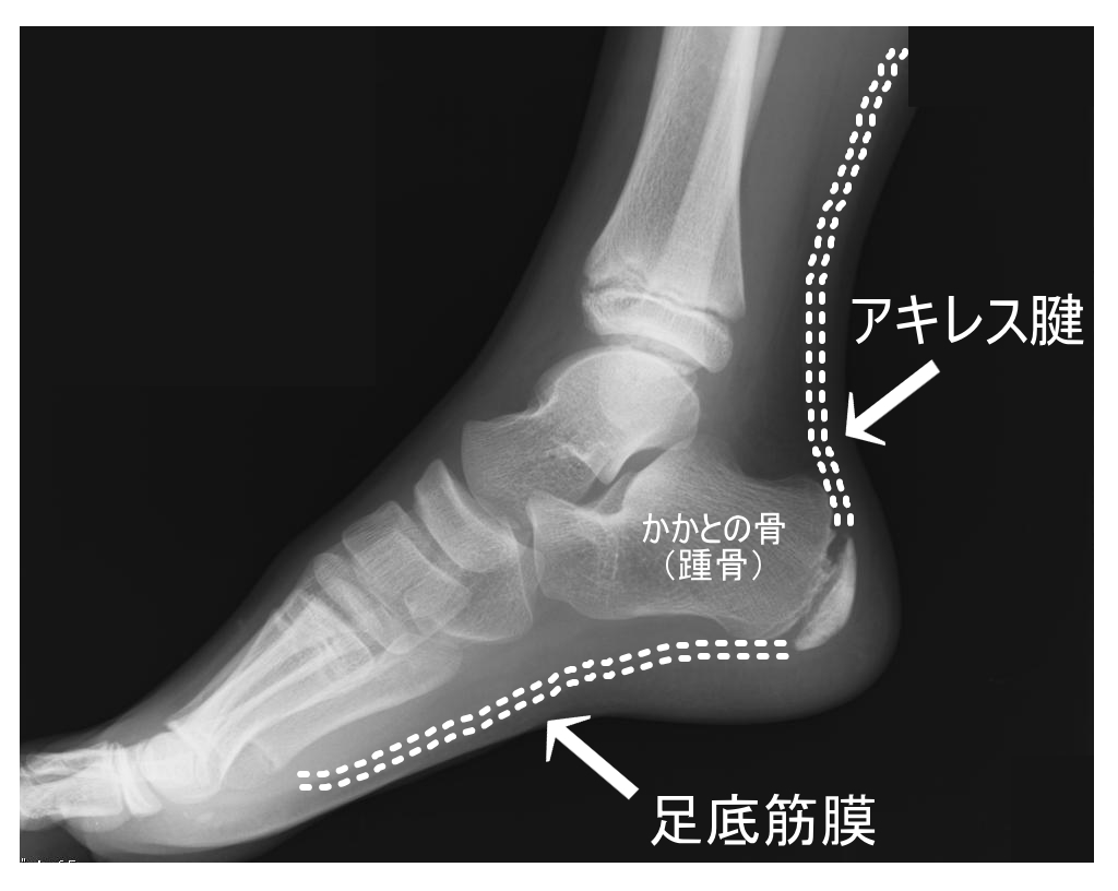 かかと 打撲 歩く と 痛い