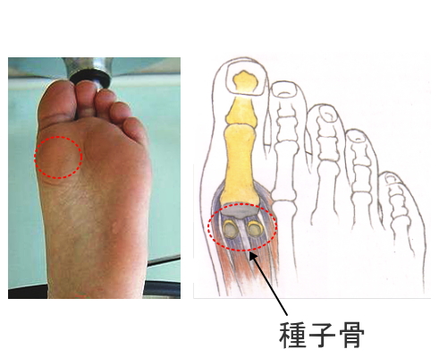 痛い 親指 の 足 付け根 の 裏