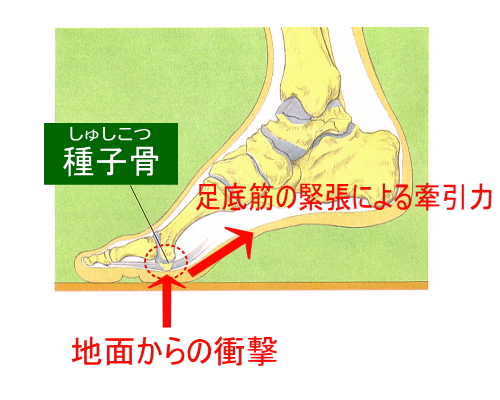 付け根 親指 足 の 痛み の 足の親指の付け根の痛み、種子骨周囲炎について。治療や自分でできるリハビリの紹介