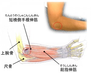 肘 は テニス と テニス肘（上腕骨外側上顆炎）とは