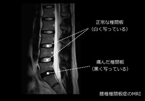 腰の痛み：腰椎椎間板症(ようついついかんばんしょう)｜よくある症状・疾患｜札幌スポーツクリニック｜札幌市中央区の整形外科・内科・リハビリ科